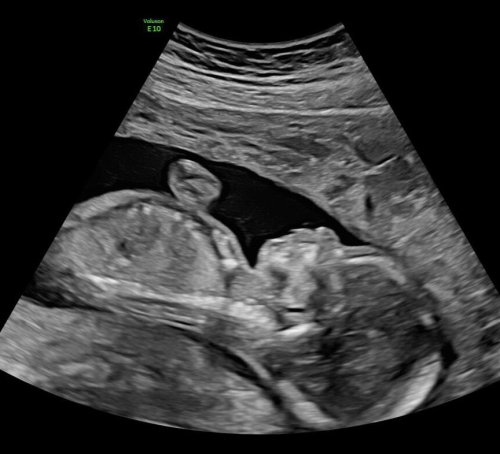 Nine's Tracy Vo was pregnant when a scan showed the unthinkable. Here's why she's sharing her story
